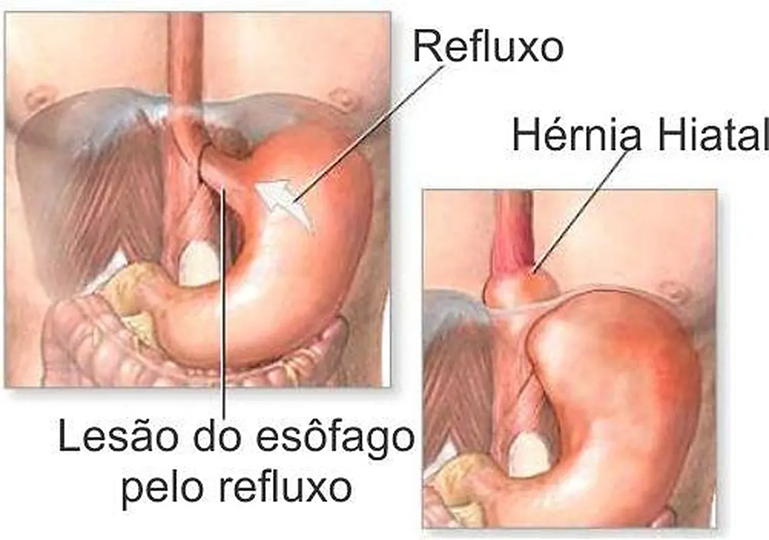 Ilustração da hérnia de hiato, com o estômago deslocado para o tórax
