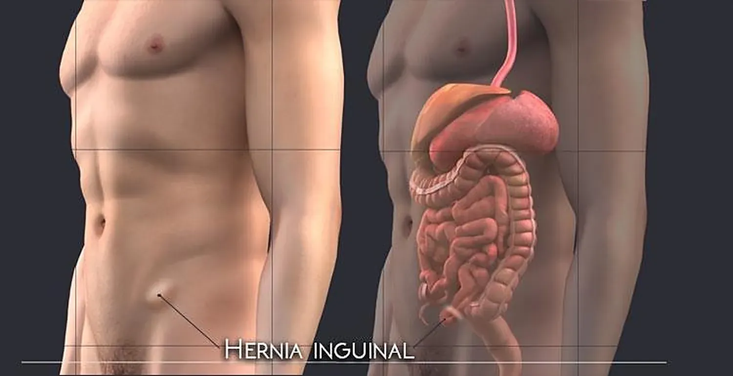 Ilustração da hérnia inguinal na região da virilha do atleta