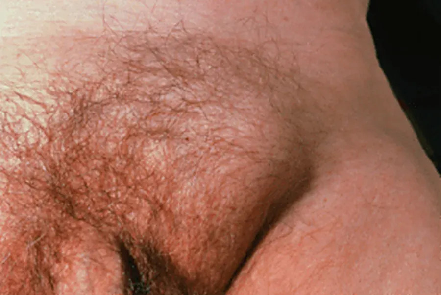 Ilustração de hérnia inguinal na região da virilha
